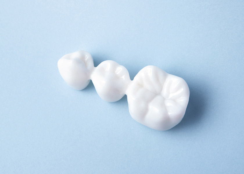 Protesi fissa - Studio Dentistico Perin Michele